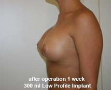 plastic-surgery-breast-augmentation